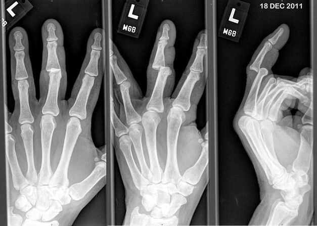 X-ray of the dislocated fingers