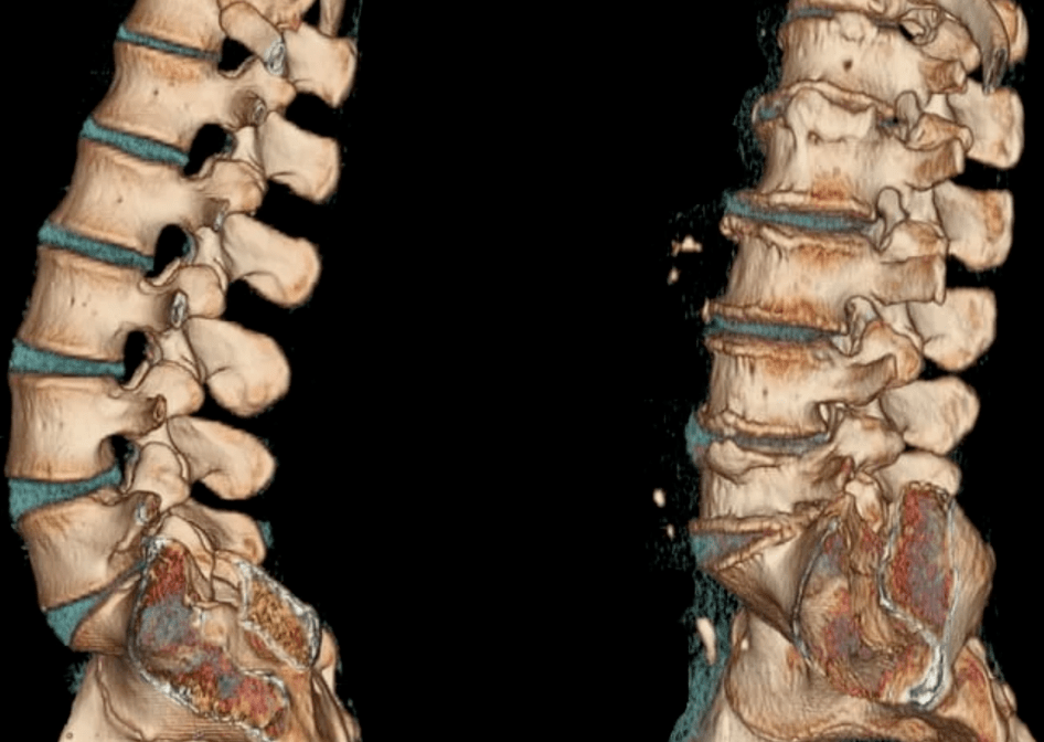 osteochondrosis