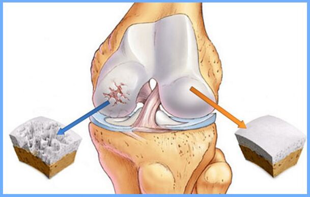Normal knee joint and affected by arthrosis