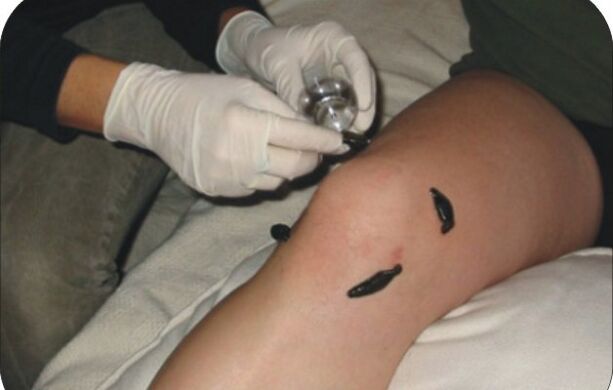 Placing leeches on a sore knee joint