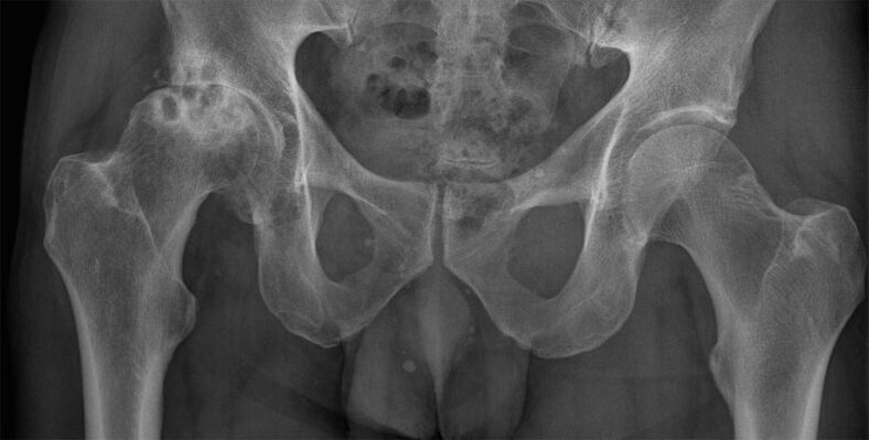 Deforming arthrosis of hip joint on x-ray