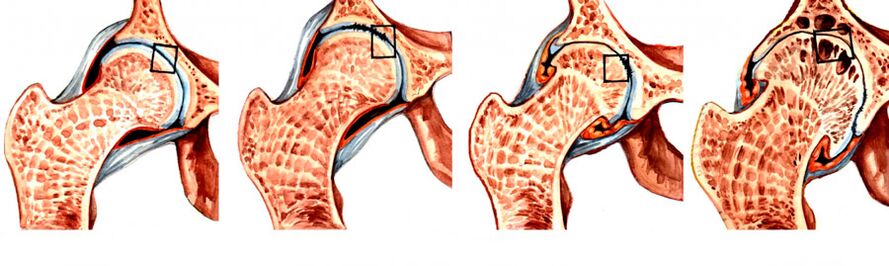 The degree of development of coxarthrosis of the hip joint