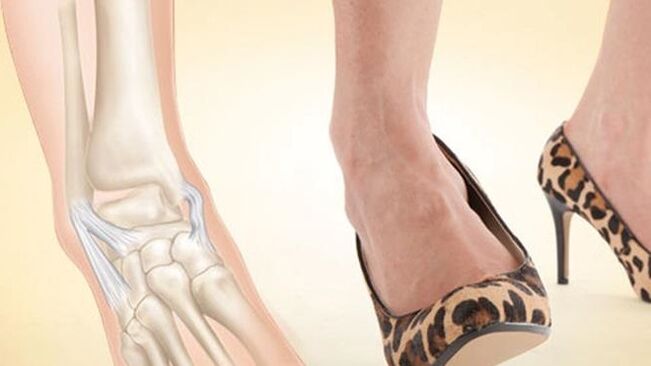 wearing shoes with heels as a cause of arthrosis of the ankle