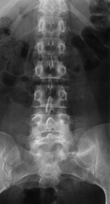 To diagnose lumbar osteochondrosis, radiography is performed