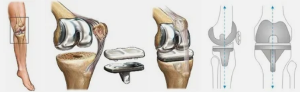 Endoprosthesis for the knee example
