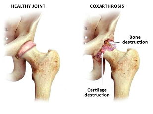 comparison of a healthy joint and hip sustave
